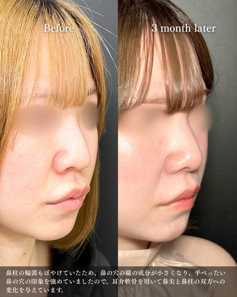 鼻尖形成と鼻中隔延長と耳介軟骨移植と小鼻縮小と鼻柱下降の症例写真 (5)