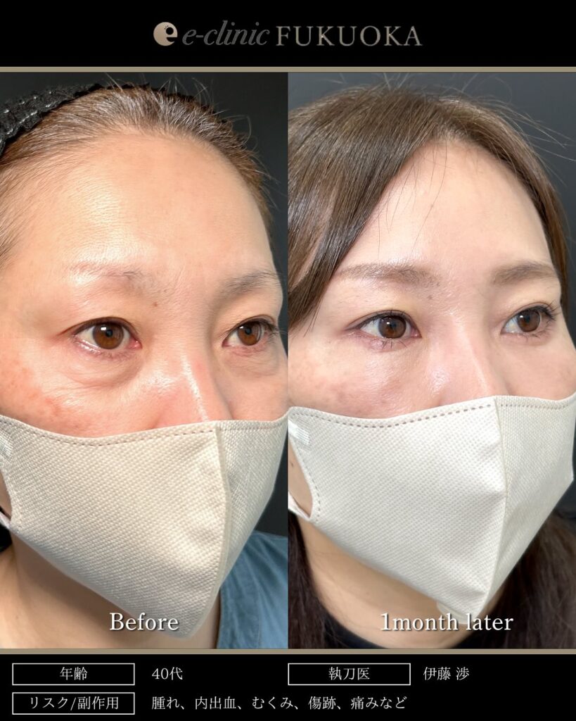 目の下のたるみ取りと脱脂と脂肪注入の症例写真 (3)