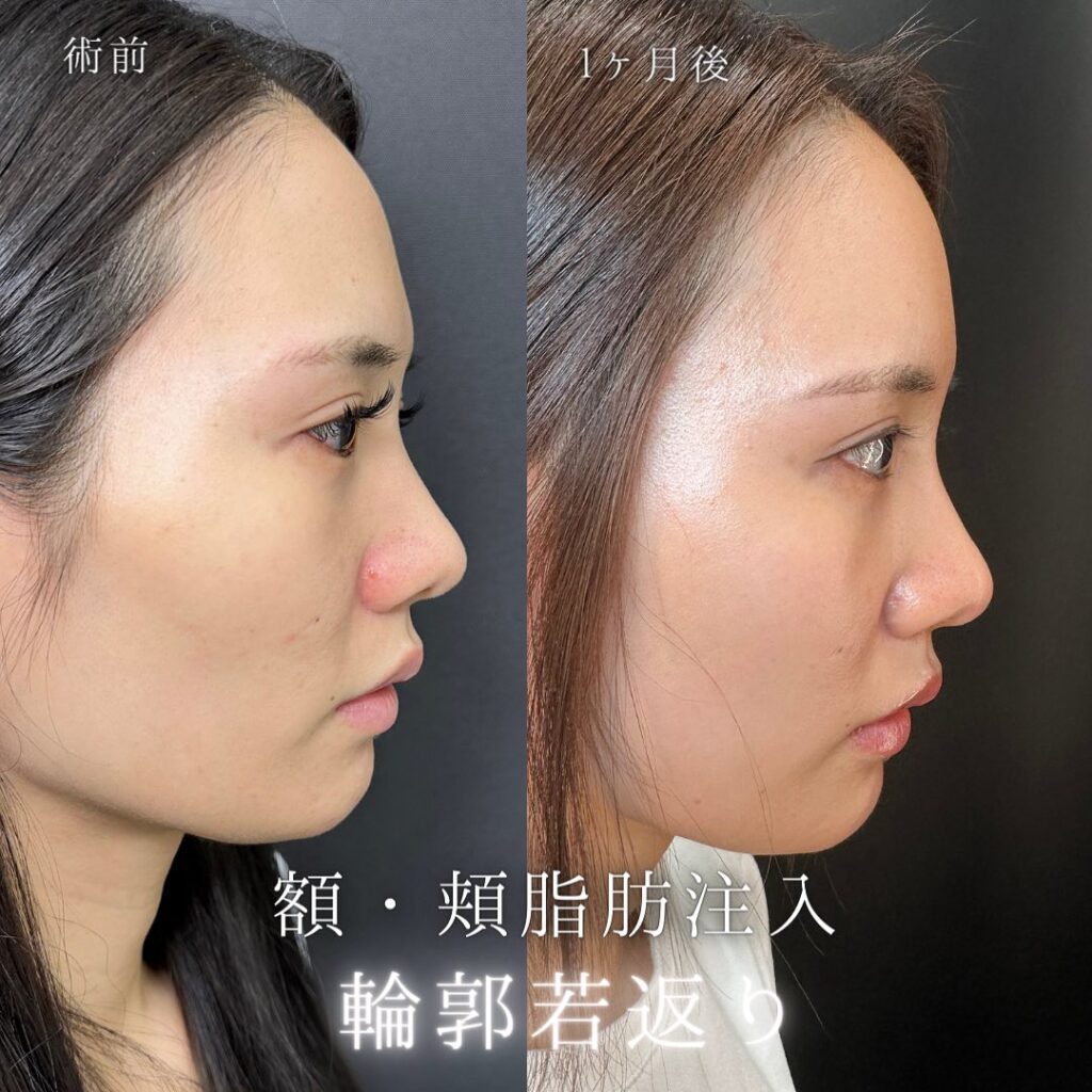 頬と額の脂肪注入と目尻切開の症例写真 (2)