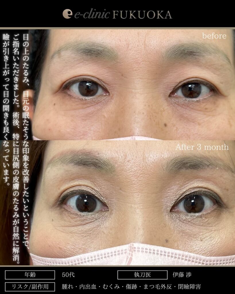 眉下切開の症例写真 (13)