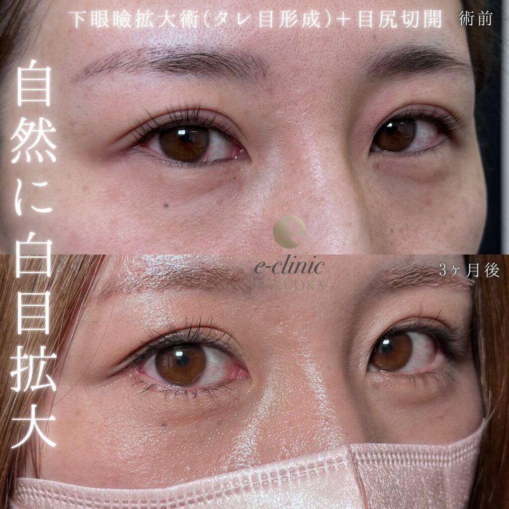 タレ目形成と目尻切開の症例写真 (6)