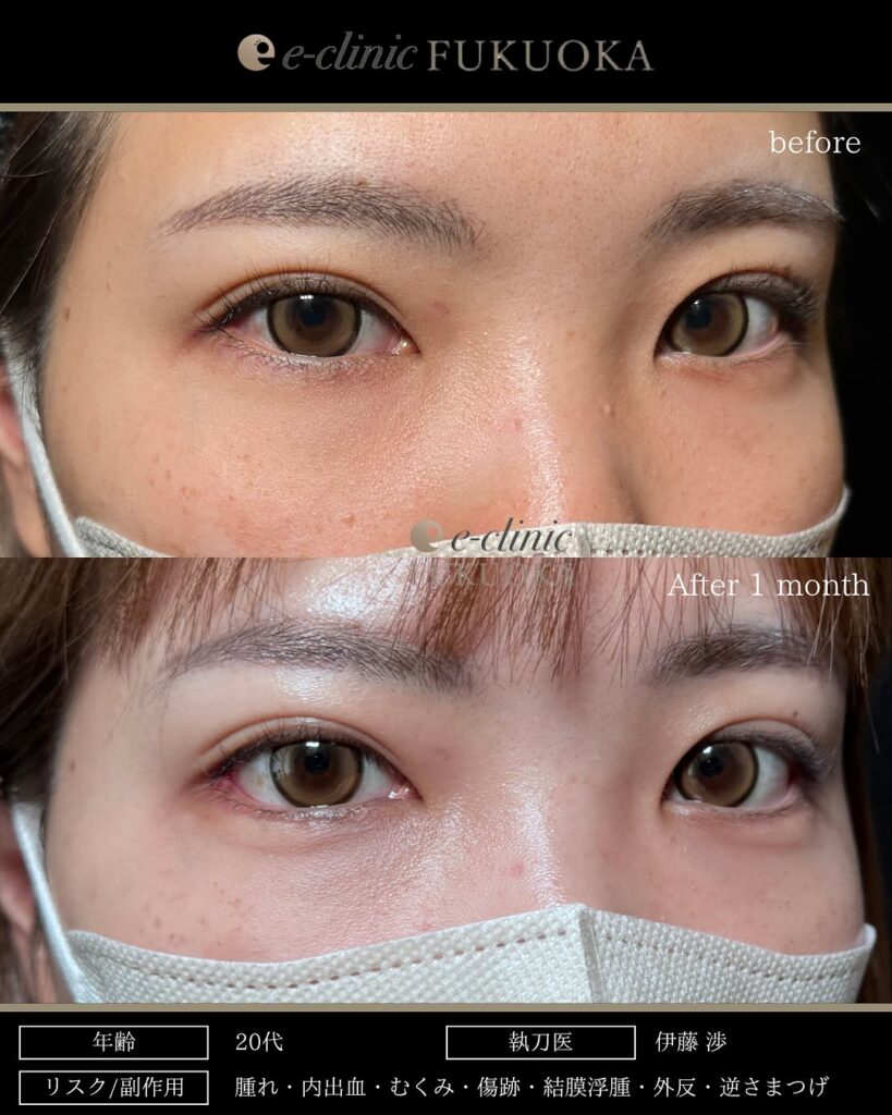 タレ目形成と目尻切開の症例写真 (13)