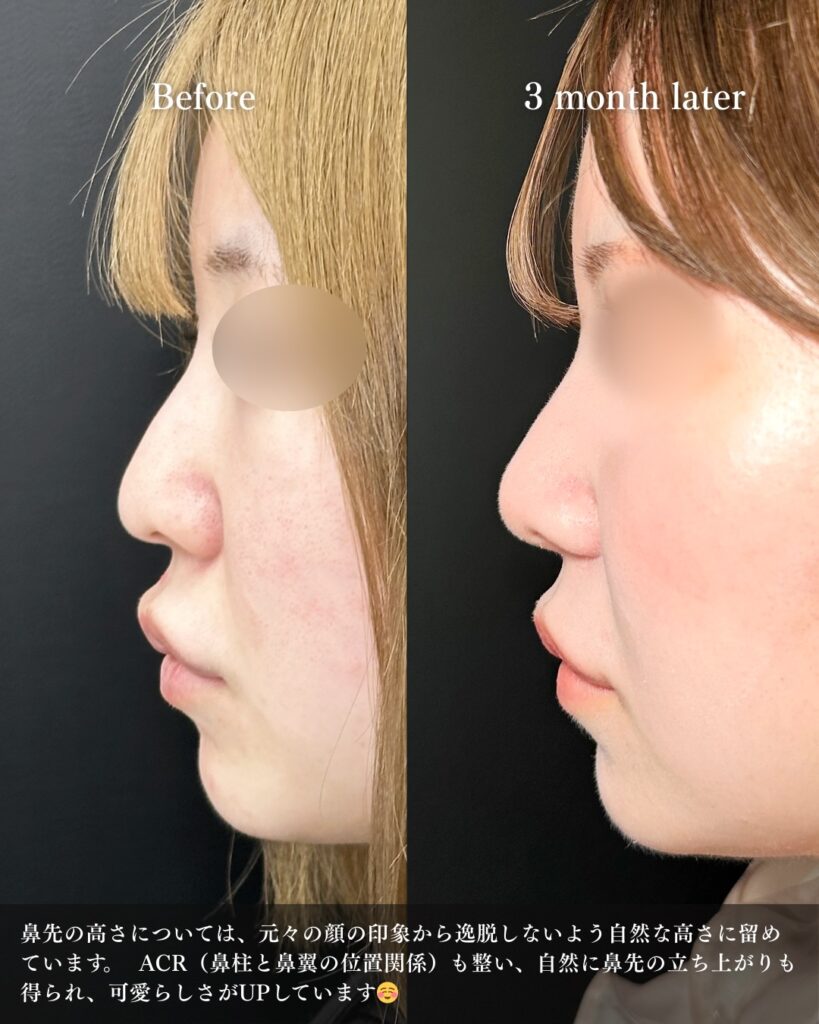 鼻尖形成と鼻中隔延長と耳介軟骨移植と小鼻縮小と鼻柱下降の症例写真 (4)