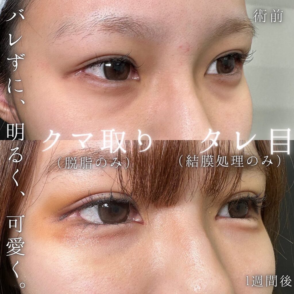 脱脂とタレ目形成の症例写真 (4)