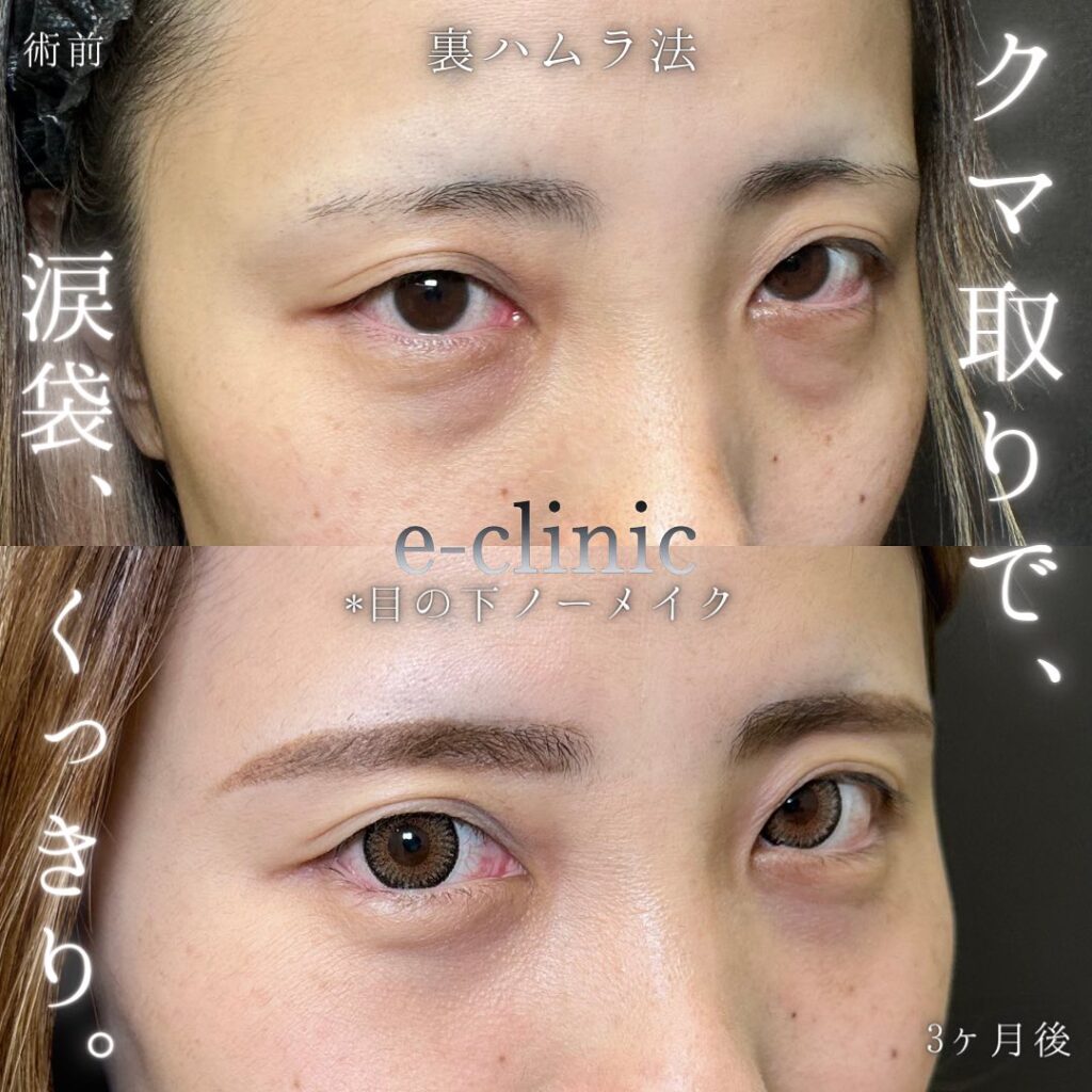 裏ハムラ法の症例写真 (58)