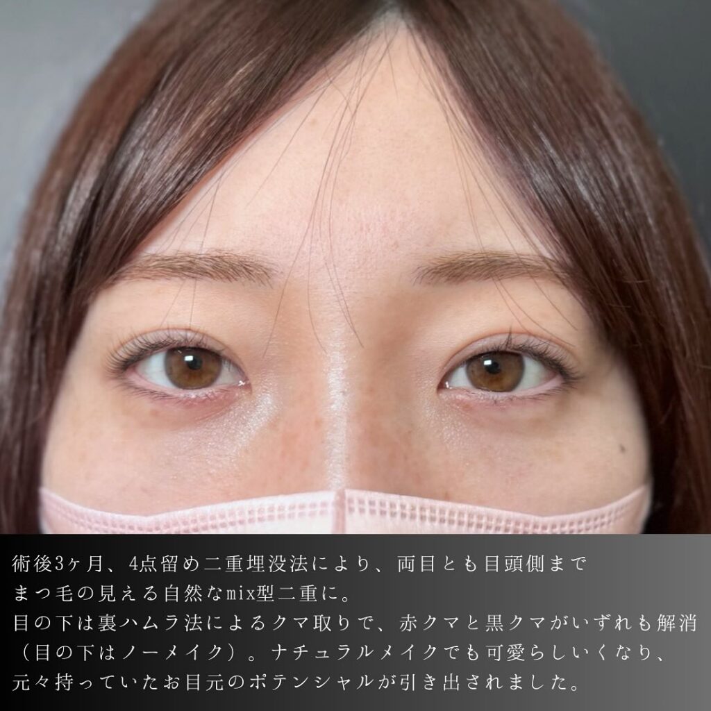 埋没法と裏ハムラ法の用例写真 (4)