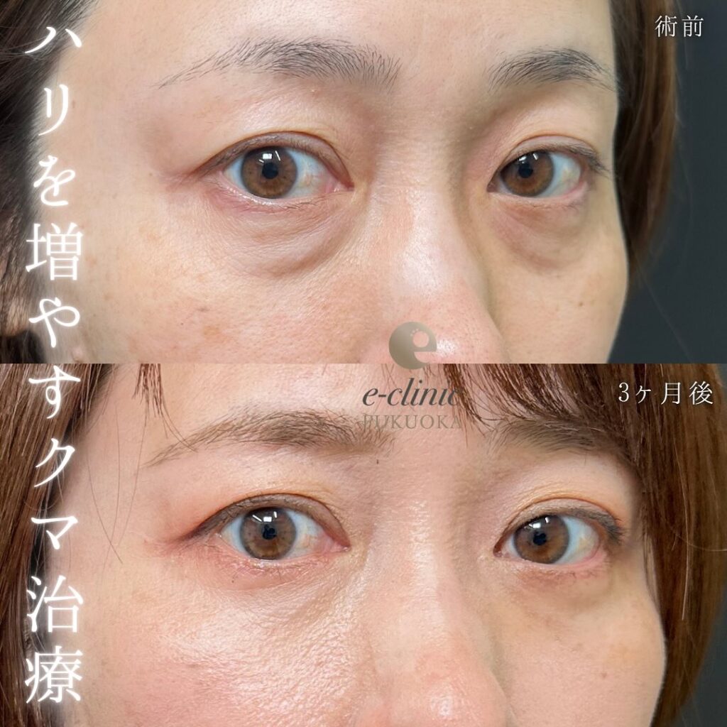 目の下のたるみ取りと裏ハムラ法と脂肪注入の症例写真 (3)