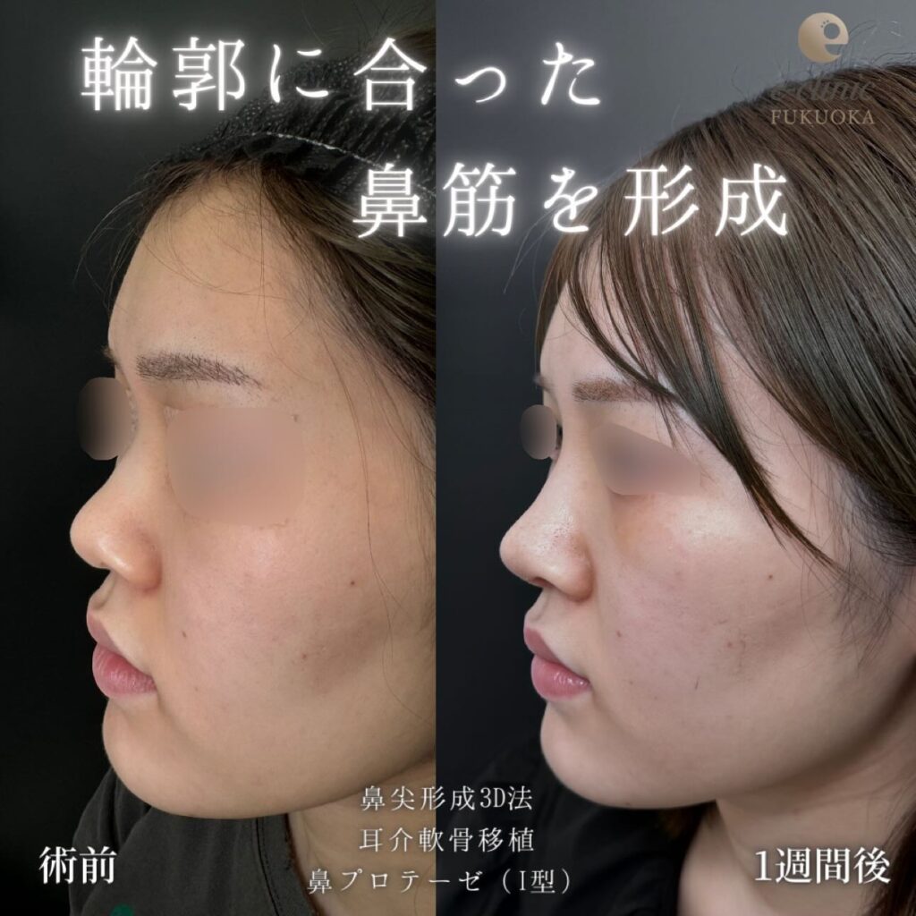 鼻尖形成と耳介軟骨移植とプロテーゼの症例写真 (4)