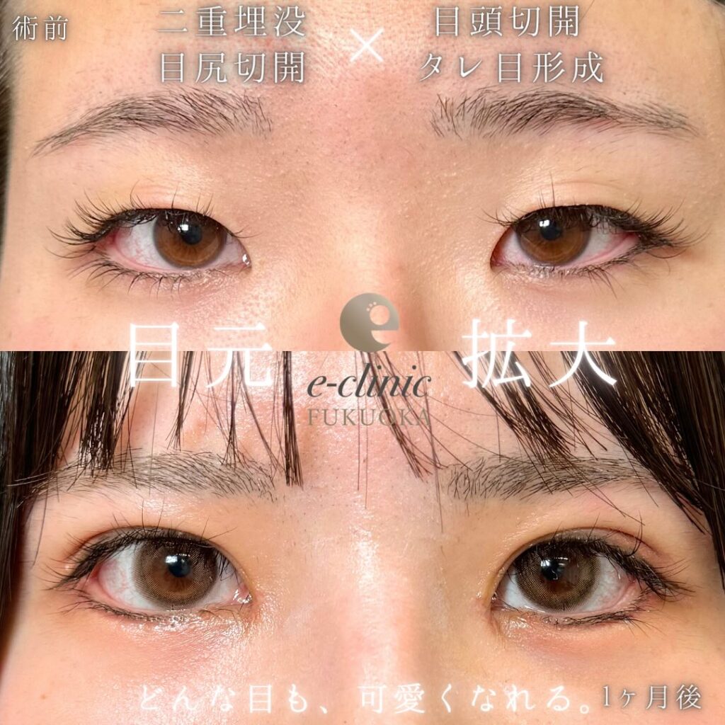 目の全方向拡大術の症例写真 (1)