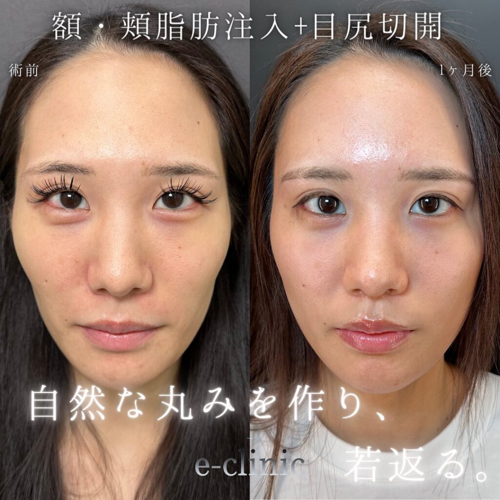 頬と額の脂肪注入と目尻切開の症例写真 (1)