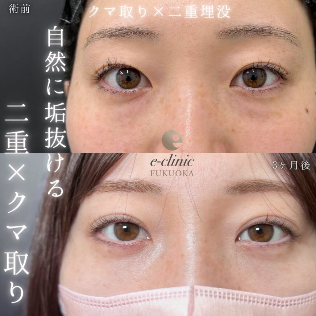 埋没法と裏ハムラ法の用例写真 (1)