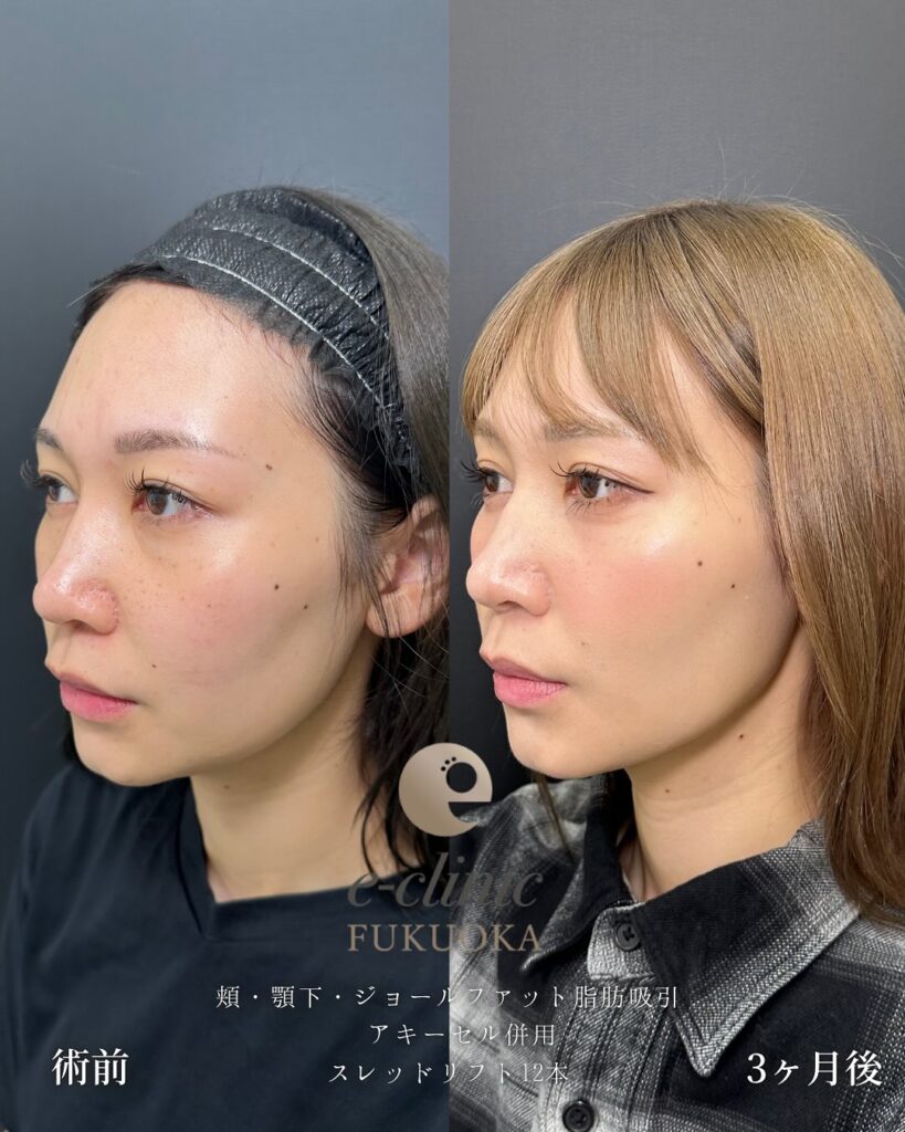 頬と顎下の脂肪吸引とジョールファットと糸リフトの症例写真 (3)