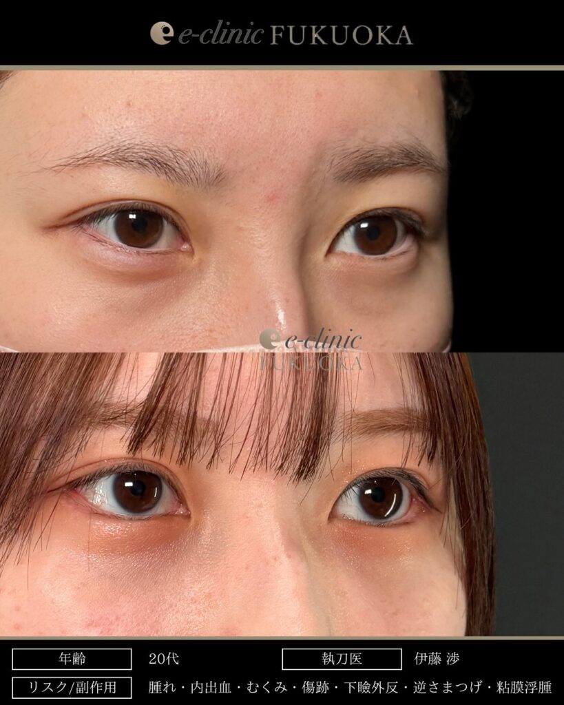 タレ目形成と目尻切開の症例写真 (10)