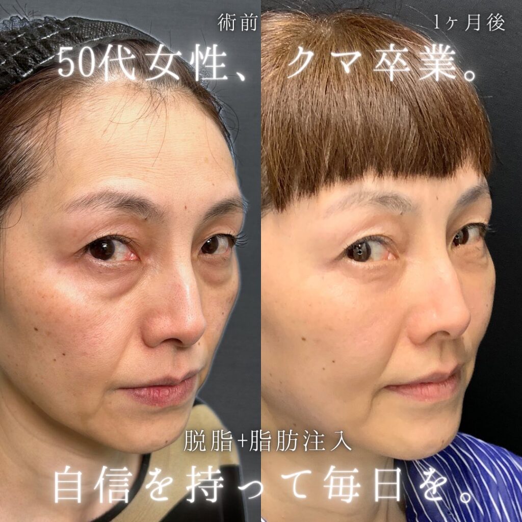 脱脂と脂肪注入の症例写真 (6)