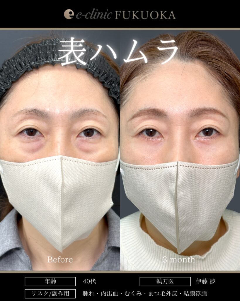 表ハムラ法の症例写真 (4)