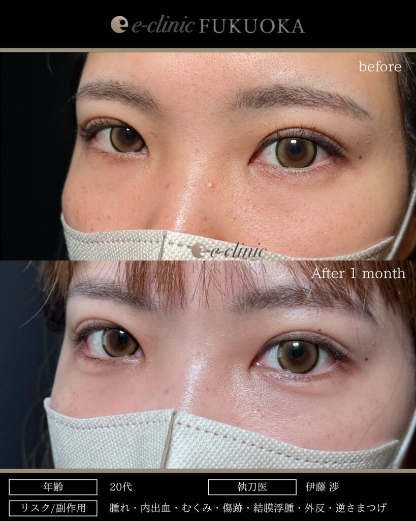 タレ目形成と目尻切開の症例写真 (17)