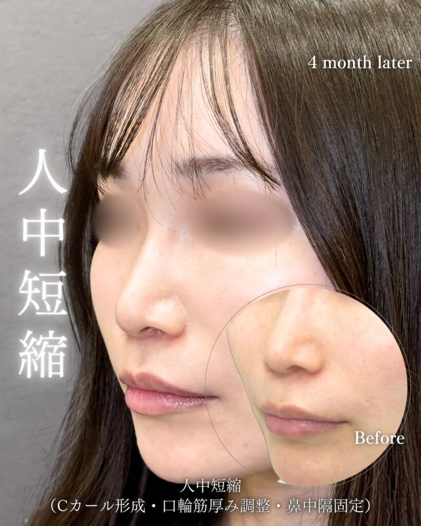 人中短縮の症例写真 (27)