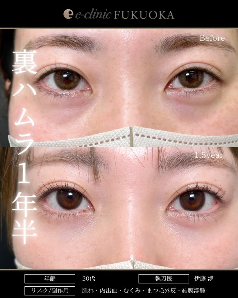 裏ハムラ法の症例写真 (94)