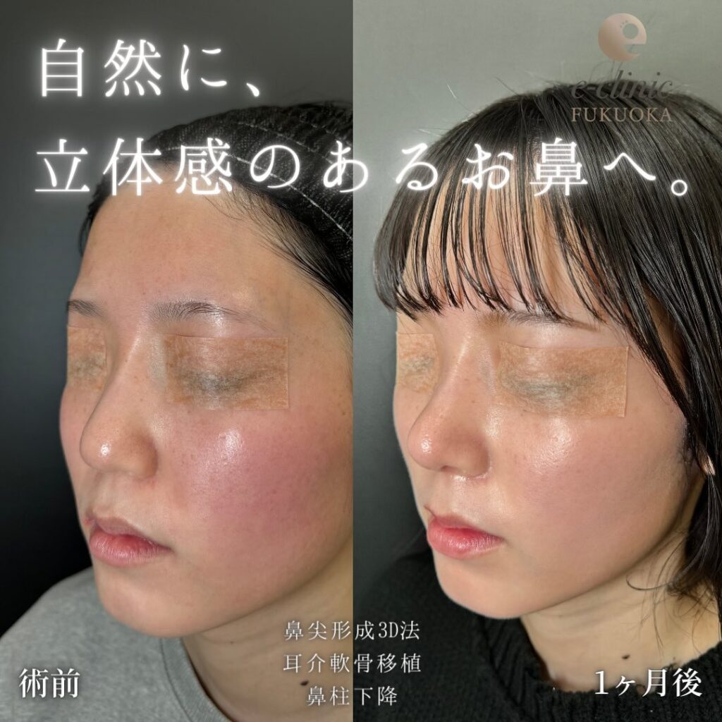 鼻尖形成と軟骨移植と鼻柱下降と他院修正の症例写真 (1)