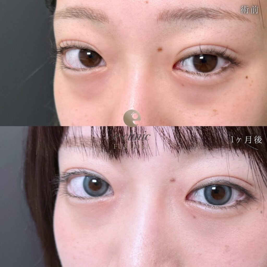 裏ハムラ法と脂肪注入の症例写真 (26)