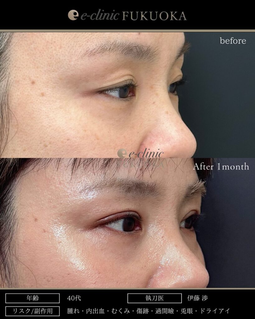 全切開と眼瞼下垂症例写真 (2)