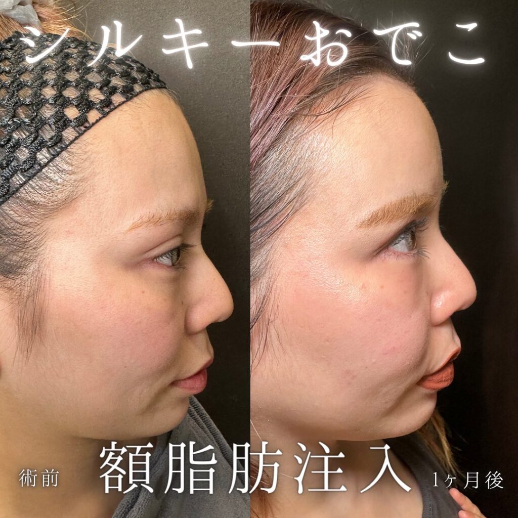 額の脂肪注入の症例写真 (3)