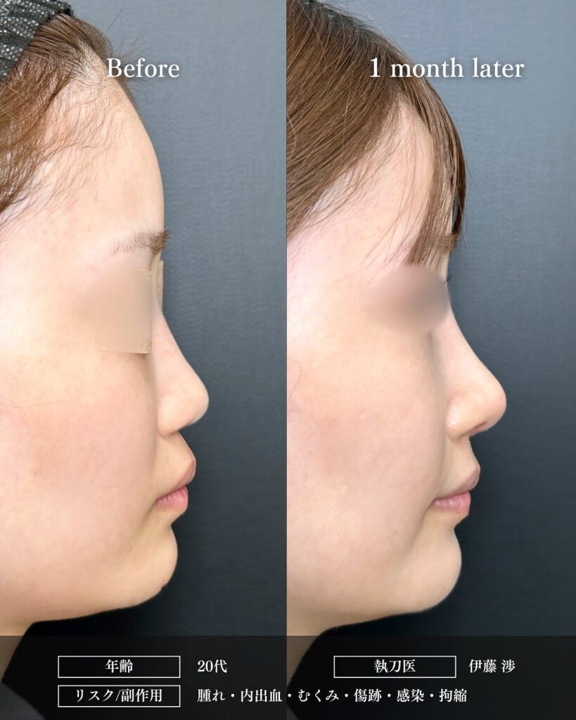 鼻中隔延長と鼻尖形成と軟骨移植とプロテーゼの症例写真 (2)