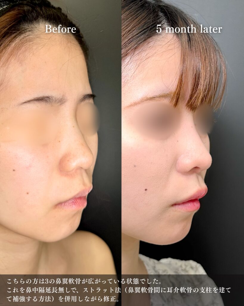 鼻尖形成と軟骨移植と鼻柱下降とプロテーゼの症例写真 (4)