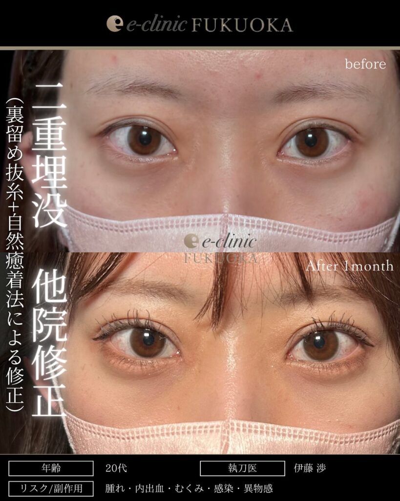 他院埋没裏留め抜糸と埋没法の症例写真 (3)