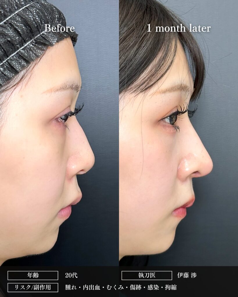 鼻中隔延長と鼻尖形成と軟骨移植と鷲鼻修正の症例写真 (3)