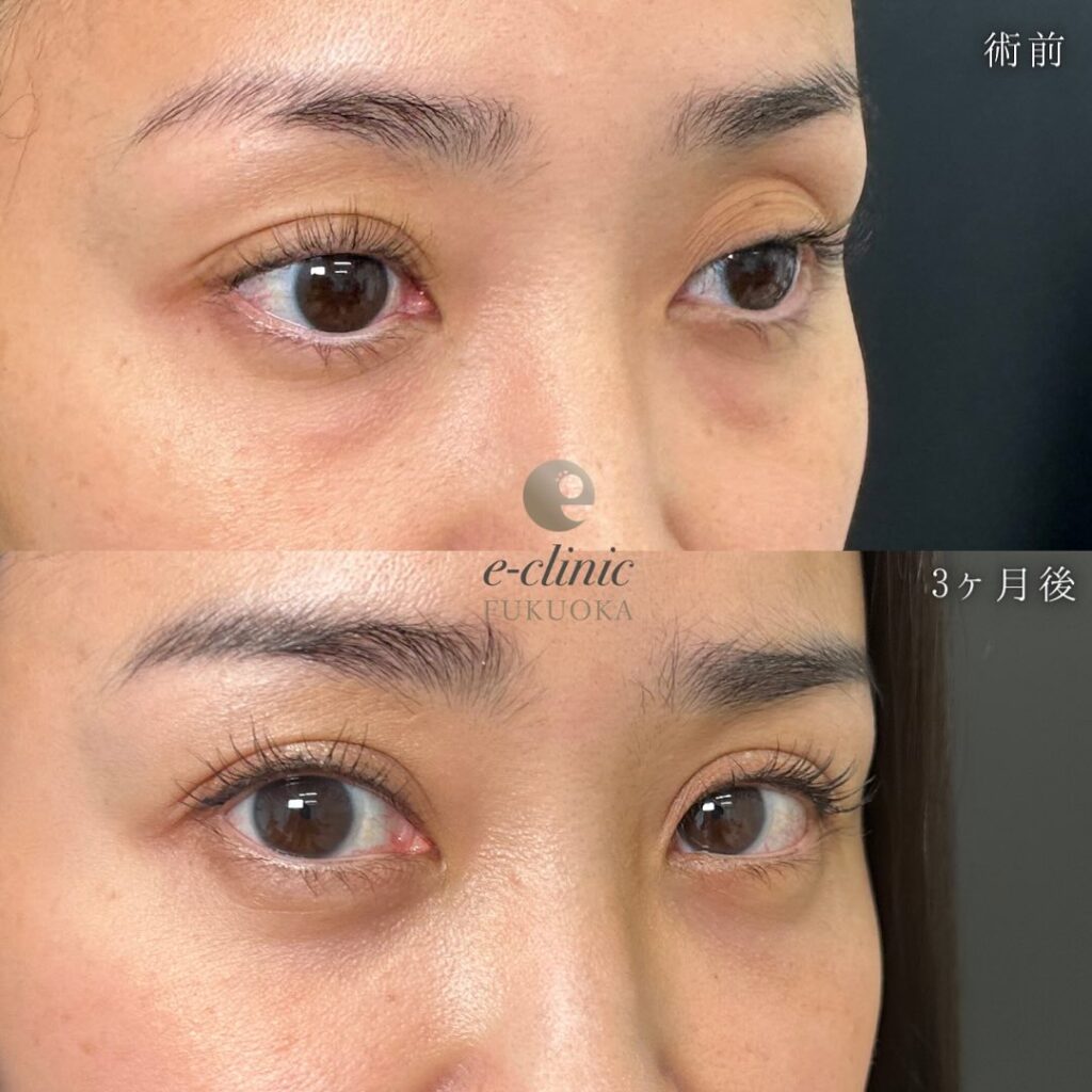 裏ハムラ法と埋没法の症例写真 (4)