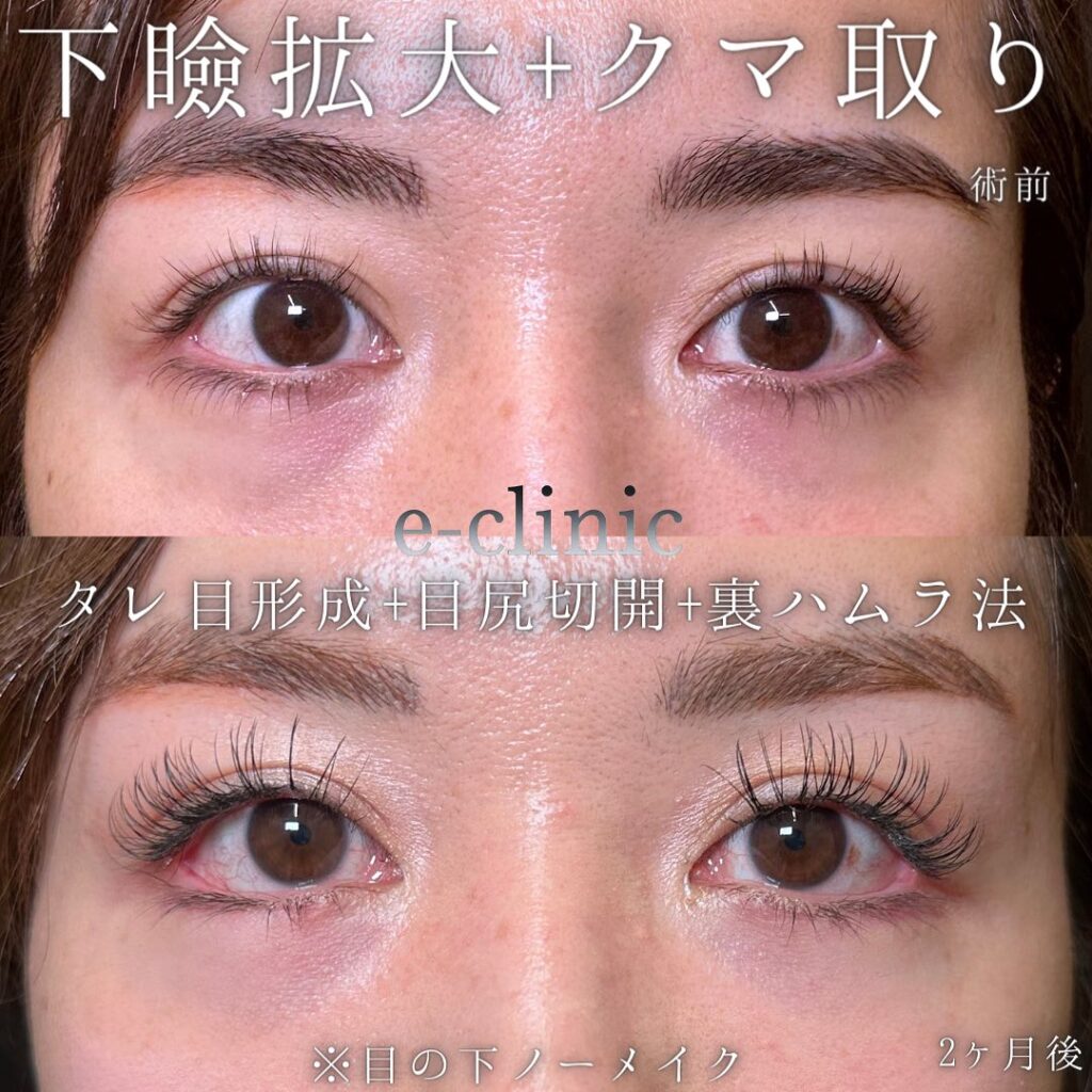 目尻切開とタレ目形成と裏ハムラ法の症例写真 (1)