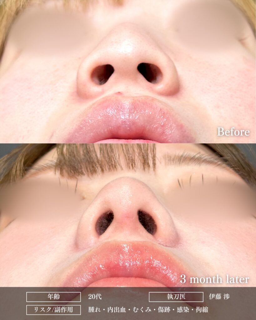 鼻尖形成と鼻中隔延長と耳介軟骨移植と小鼻縮小と鼻柱下降の症例写真 (2)