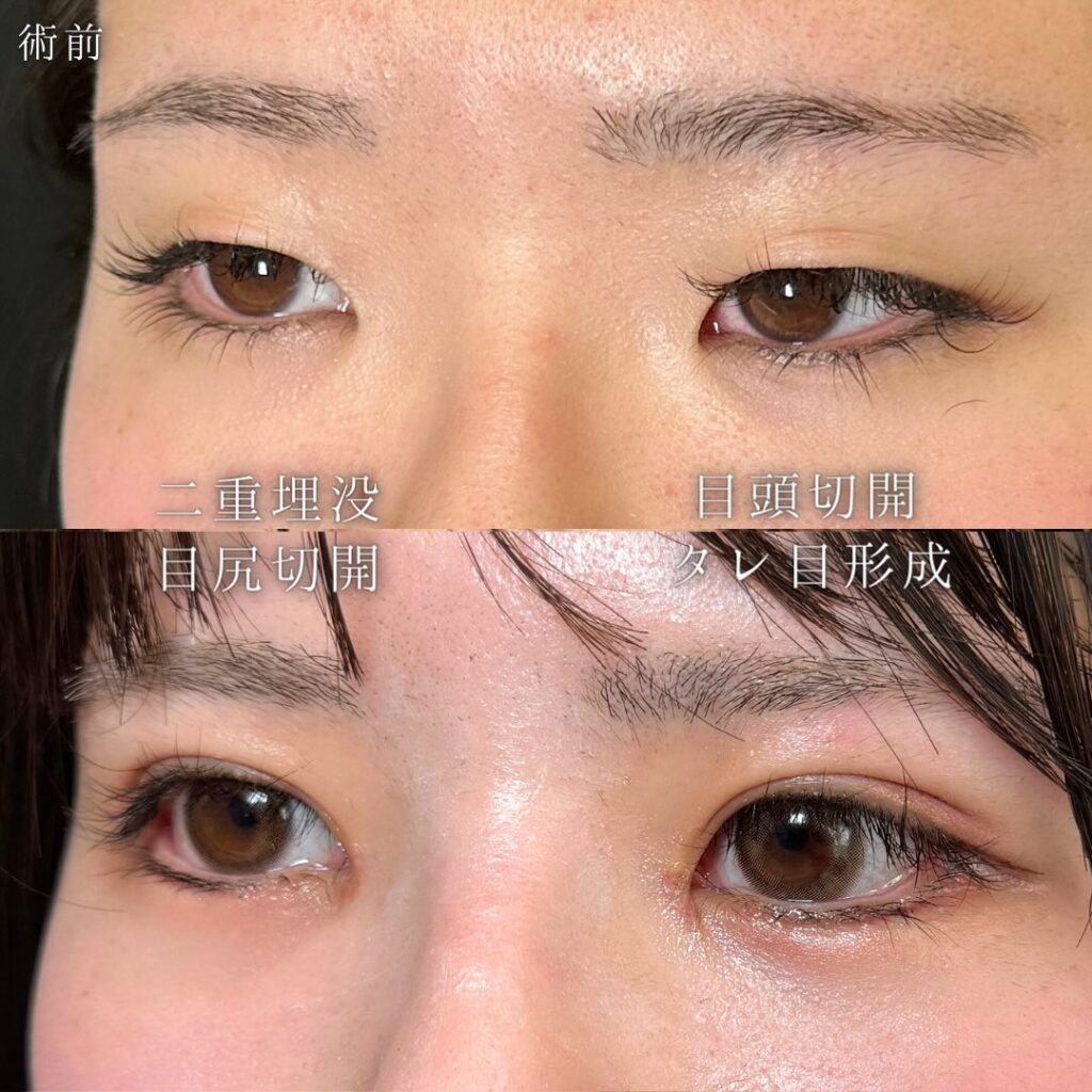 目の全方向拡大術の症例写真 (3)