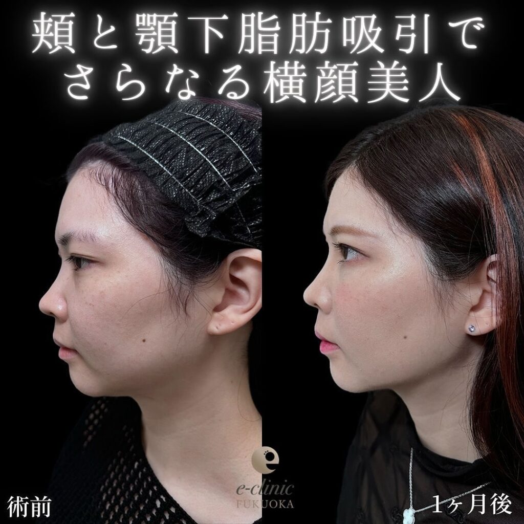 頬と顎下の脂肪吸引の症例写真 (1)