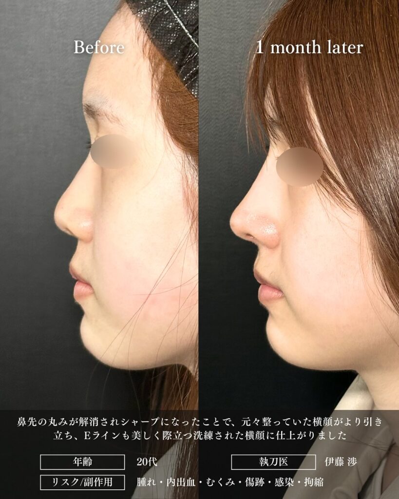 鼻尖形成と鼻中隔延長と耳介軟骨移植とプロテーゼと小鼻縮小の症例写真 (3)