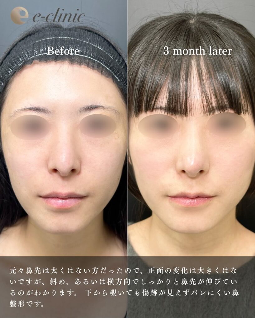 鼻尖形成+軟骨移植の症例写真 (3)