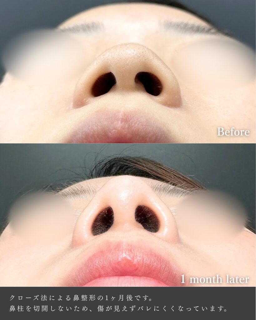 鼻尖形成と軟骨移植とプロテーゼの症例写真 (21)