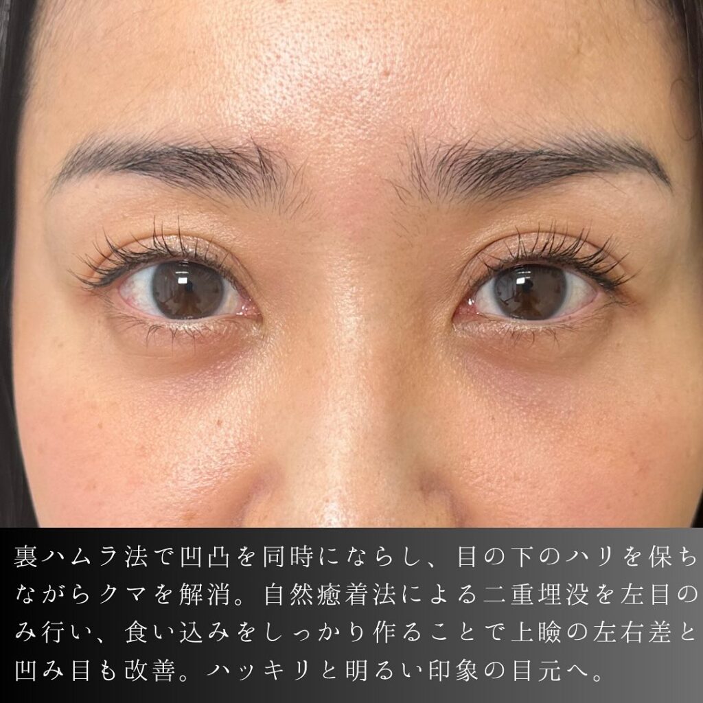 裏ハムラ法と埋没法の症例写真 (5)