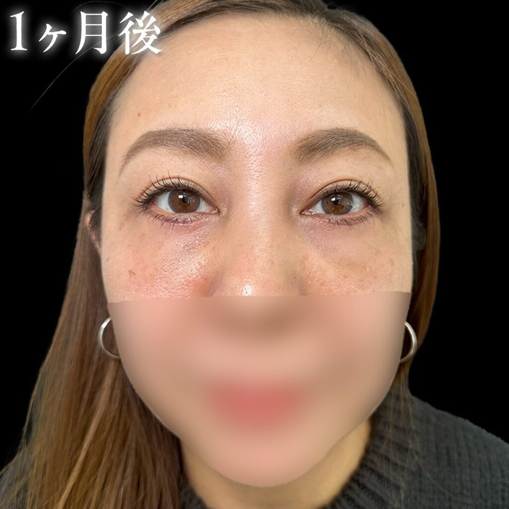 目の下のクマ取りと裏ハムラ法と目の下の脂肪注入の症例写真 (3)