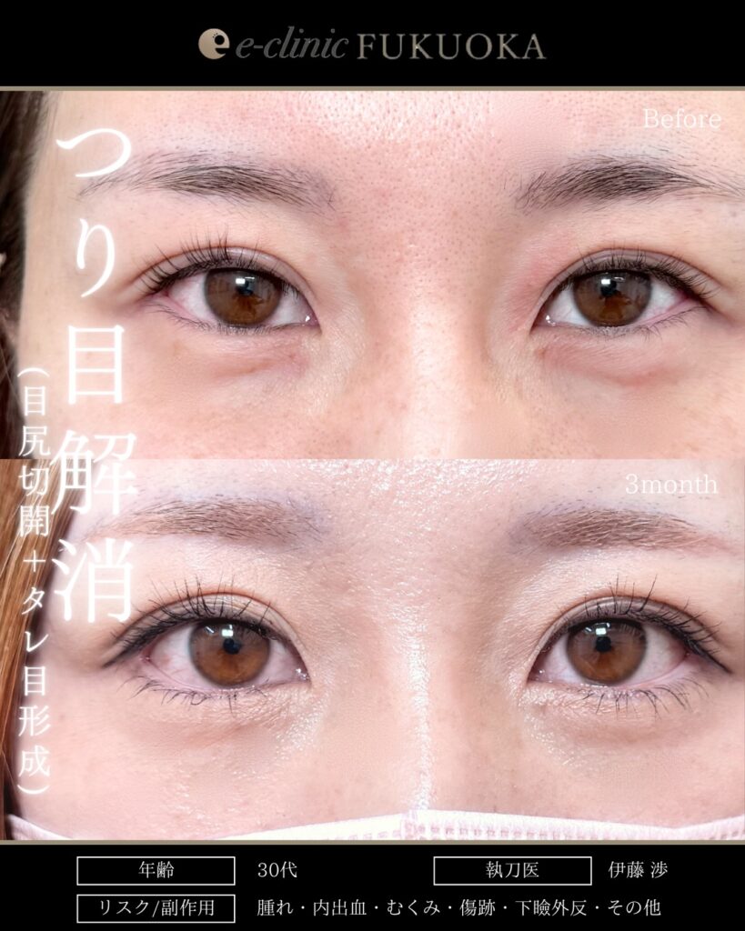 タレ目形成と目尻切開と脱脂とクマ取りの症例写真 (1)