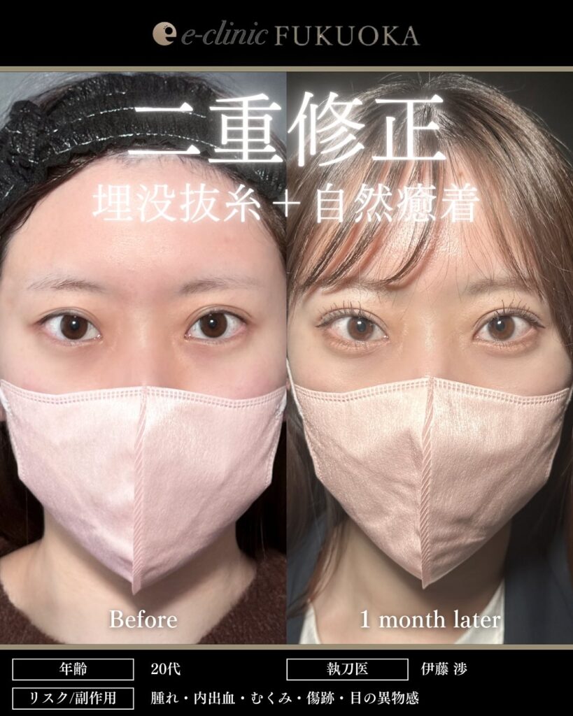 他院埋没裏留め抜糸と自然癒着法の症例写真 (1)