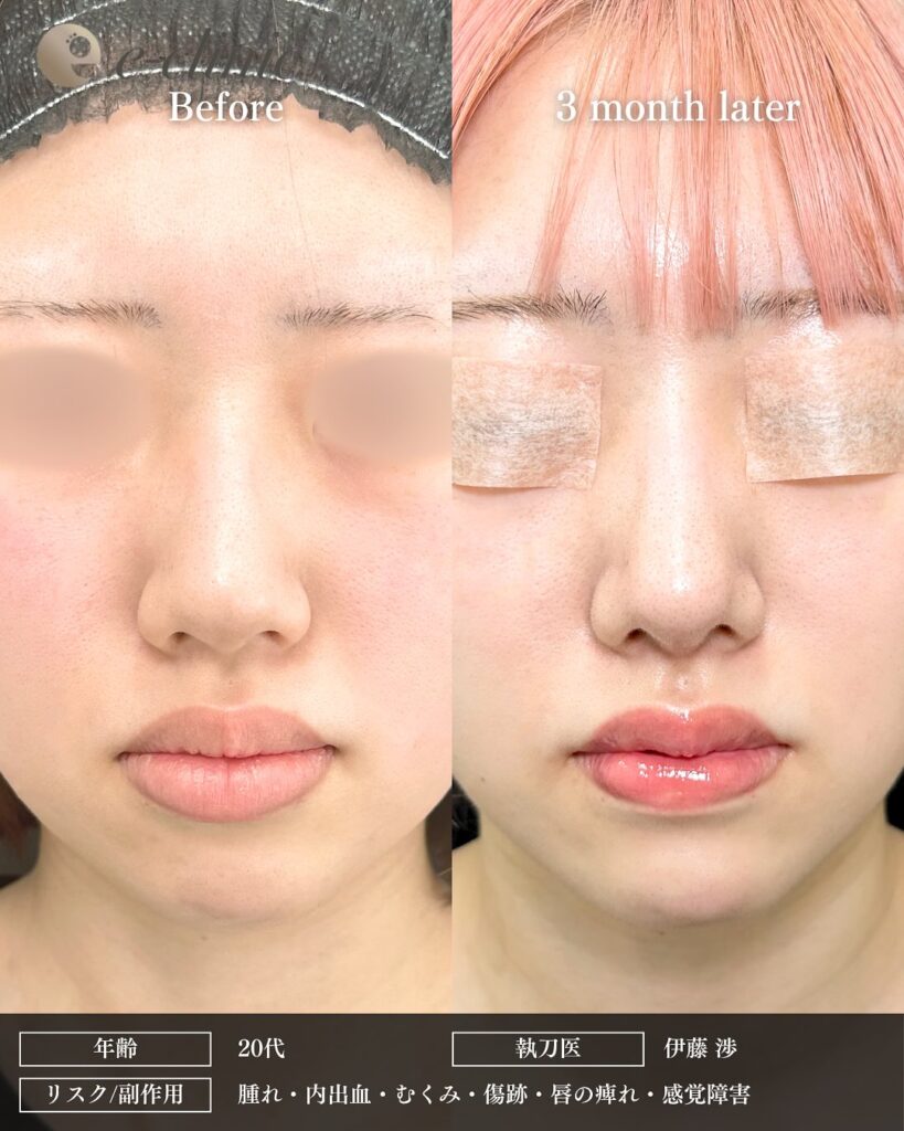 鼻尖形成と軟骨移植と口唇縮小の症例写真 (6)