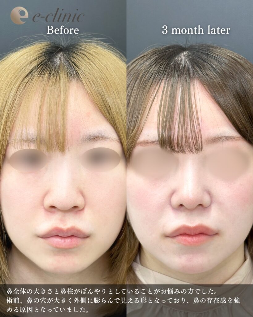 鼻尖形成と鼻中隔延長と耳介軟骨移植と小鼻縮小と鼻柱下降の症例写真 (7)