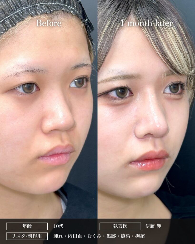 鼻中隔延長と鼻尖形成と軟骨移植と小鼻縮小と鼻柱下降とプロテーゼの症例写真 (8)