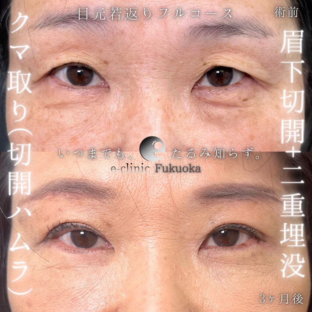 切開ハムラと眉下切開と埋没法の症例写真 (1)