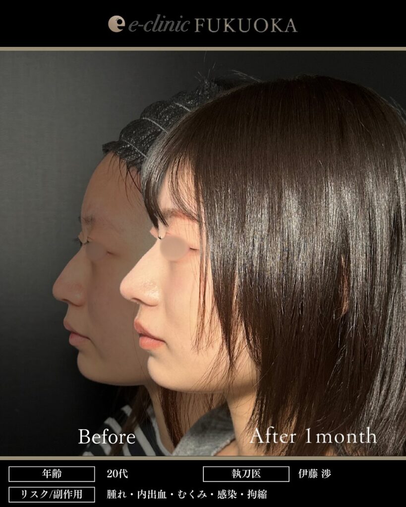 鼻尖形成と耳介軟骨移植と小鼻縮小と鼻柱下降の症例写真 (3)