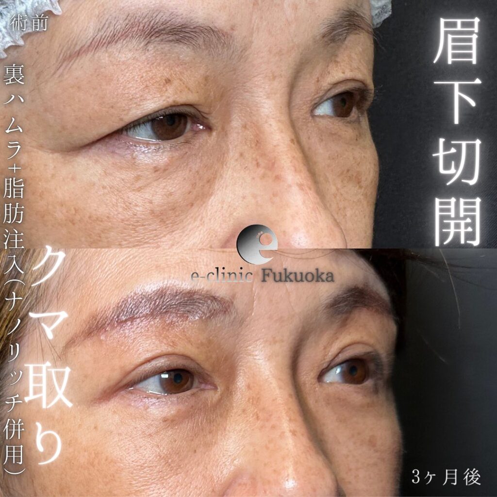裏ハムラ方と眉下切開と脂肪注入の症例写真 (3)