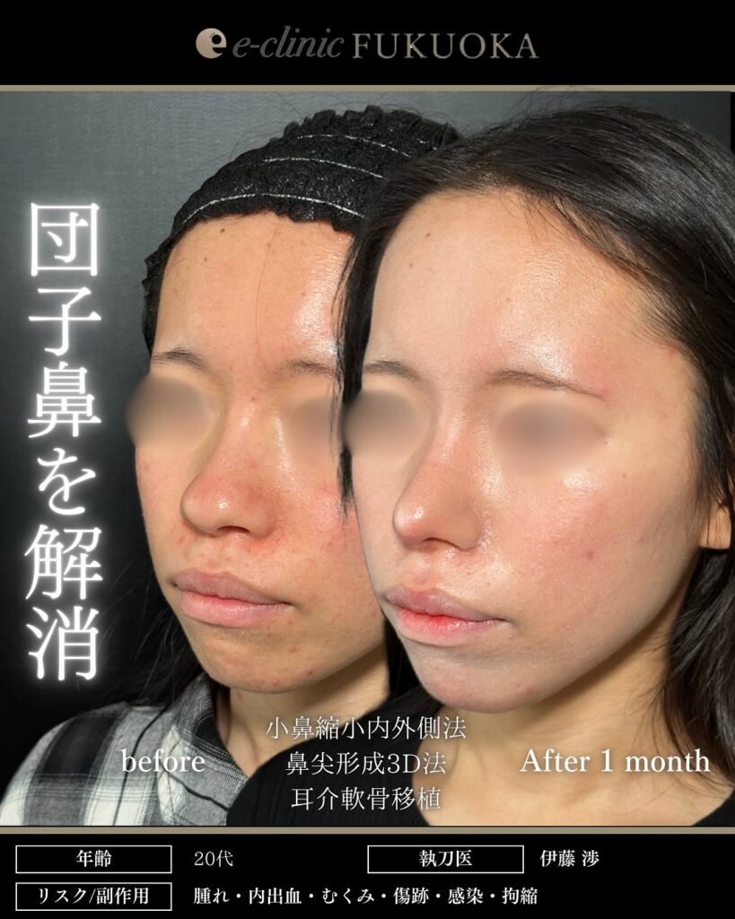 鼻尖形成と軟骨移植と小鼻縮小の症例写真 (23)