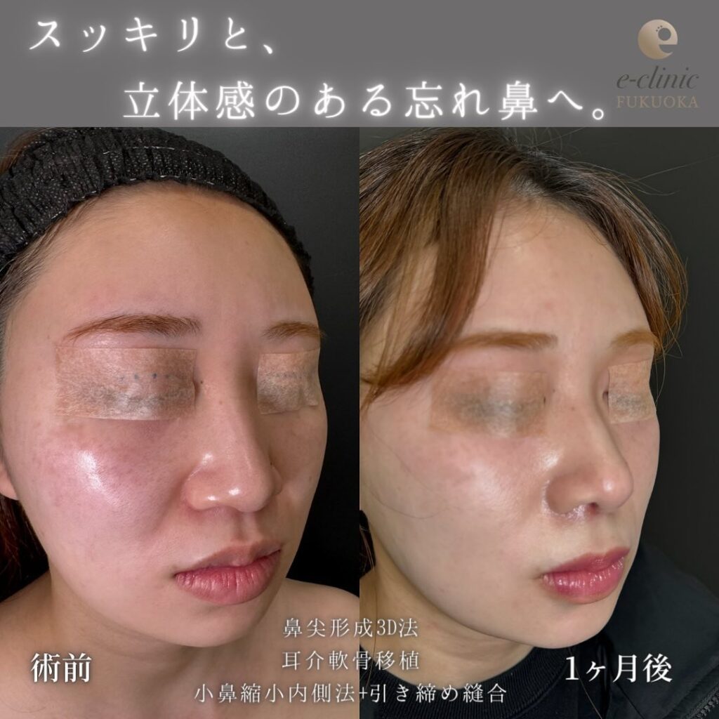 鼻尖形成と軟骨移植と小鼻縮小の症例写真 (10)